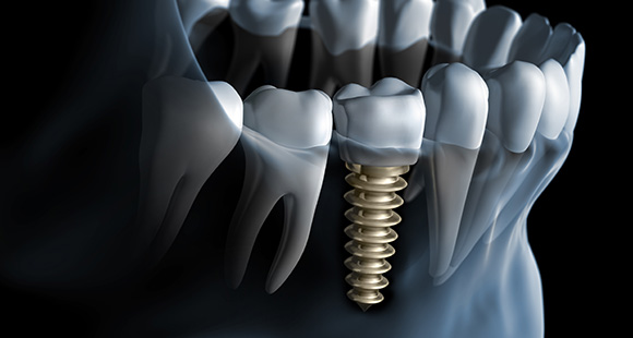 images/leistungen/bild-quartierpraxis-zahnarzt-leistungen-implantate.jpg